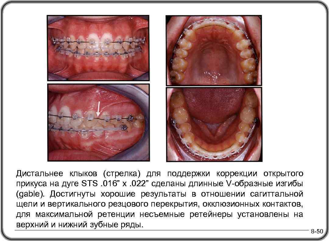 Дистальнее клыков (стрелка) для поддержки коррекции открытого прикуса на дуге STS. 016” x. 022”