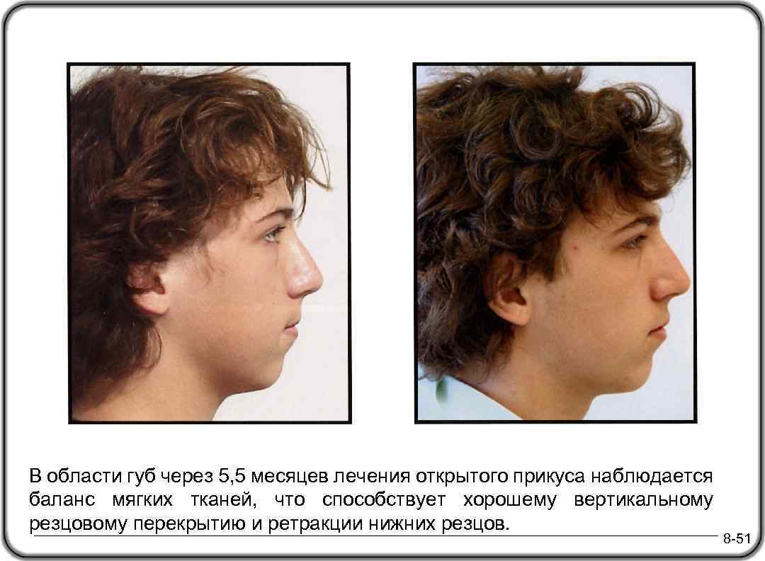В области губ через 5, 5 месяцев лечения открытого прикуса наблюдается баланс мягких тканей,