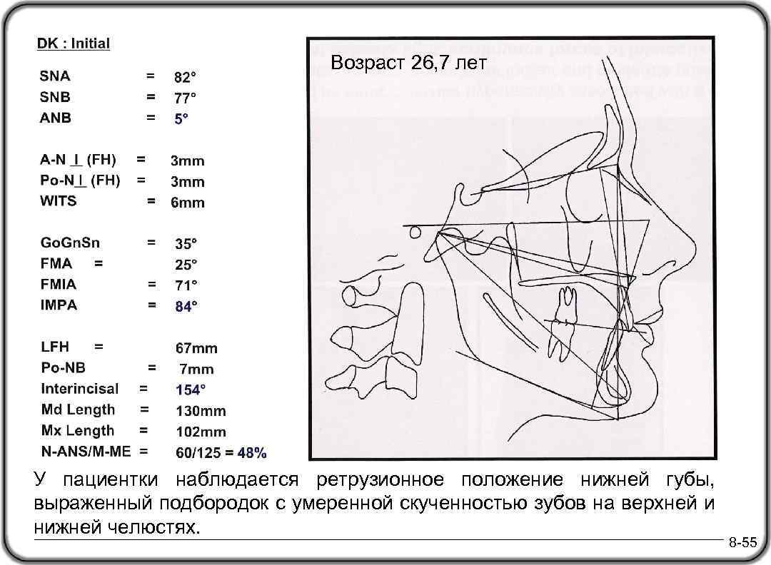 Возраст 26, 7 лет У пациентки наблюдается ретрузионное положение нижней губы, выраженный подбородок с