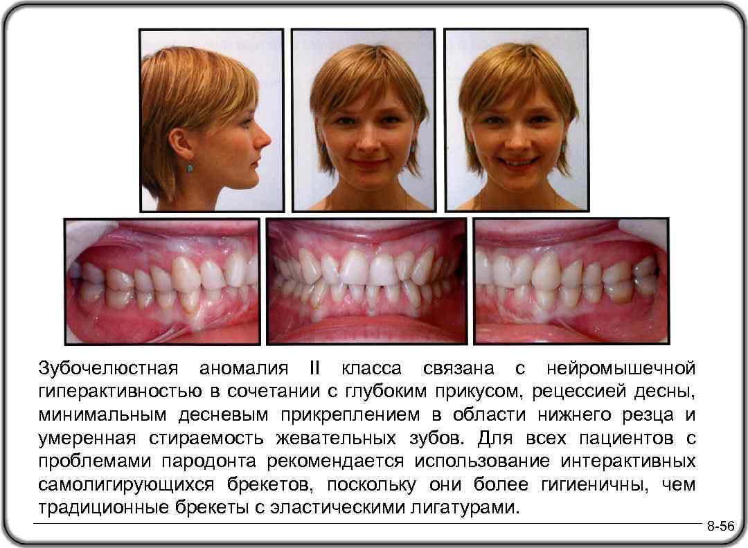 Зубочелюстная аномалия II класса связана с нейромышечной гиперактивностью в сочетании с глубоким прикусом, рецессией