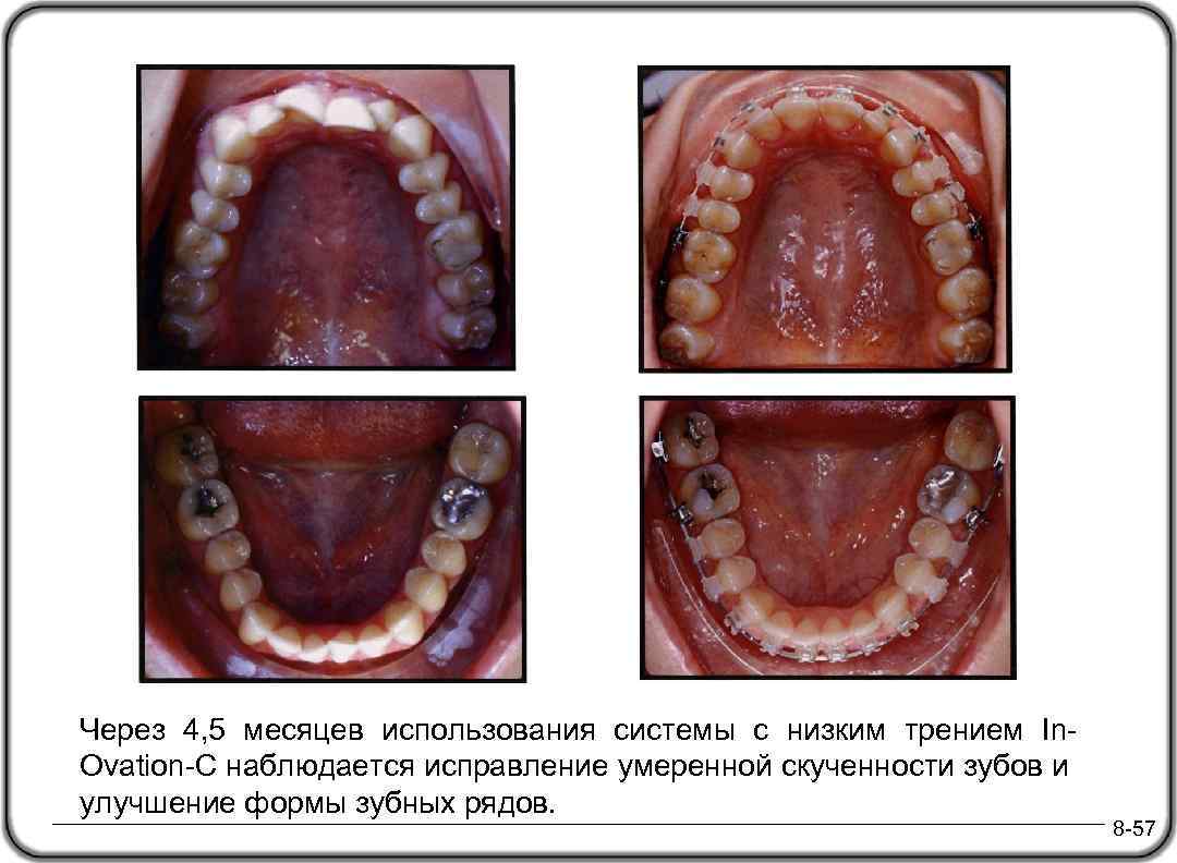 Через 4, 5 месяцев использования системы с низким трением In. Ovation-C наблюдается исправление умеренной