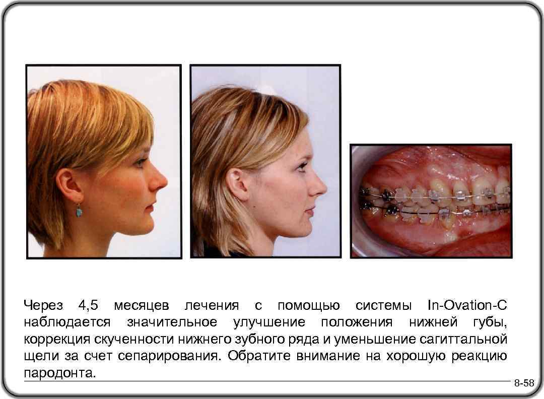 Через 4, 5 месяцев лечения с помощью системы In-Ovation-C наблюдается значительное улучшение положения нижней