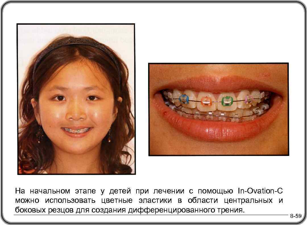 На начальном этапе у детей при лечении с помощью In-Ovation-C можно использовать цветные эластики