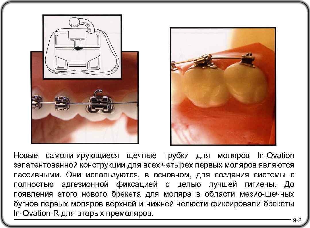 Новые самолигирующиеся щечные трубки для моляров In-Ovation запатентованной конструкции для всех четырех первых моляров