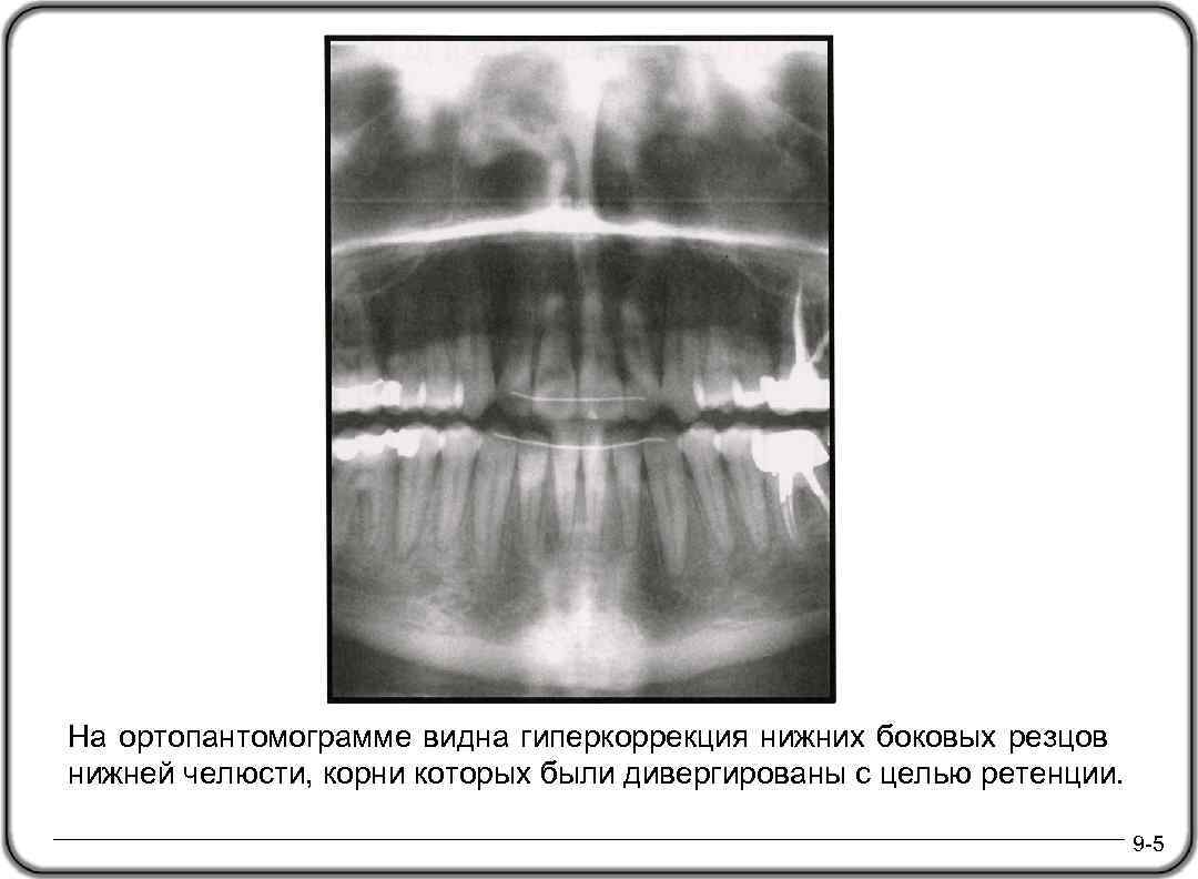 На ортопантомограмме видна гиперкоррекция нижних боковых резцов нижней челюсти, корни которых были дивергированы с