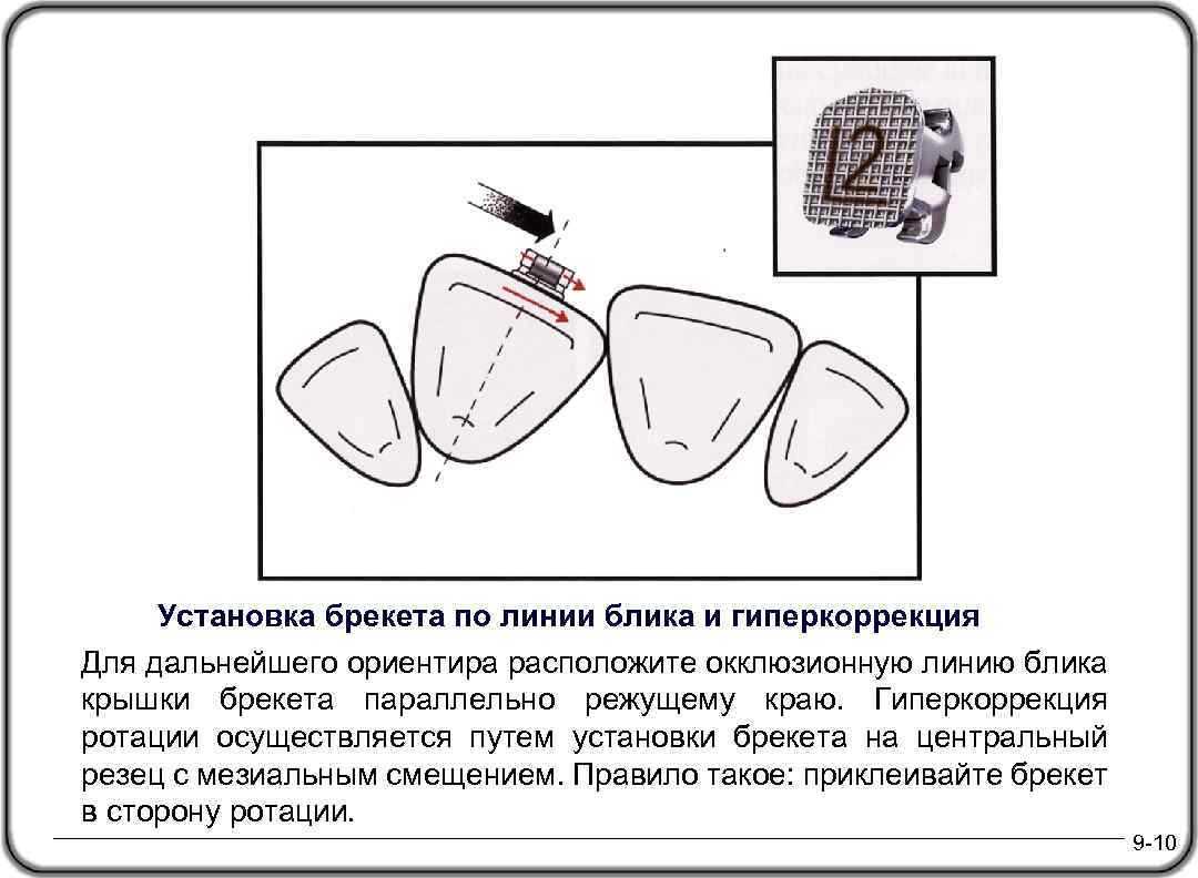 Установка брекета по линии блика и гиперкоррекция Для дальнейшего ориентира расположите окклюзионную линию блика