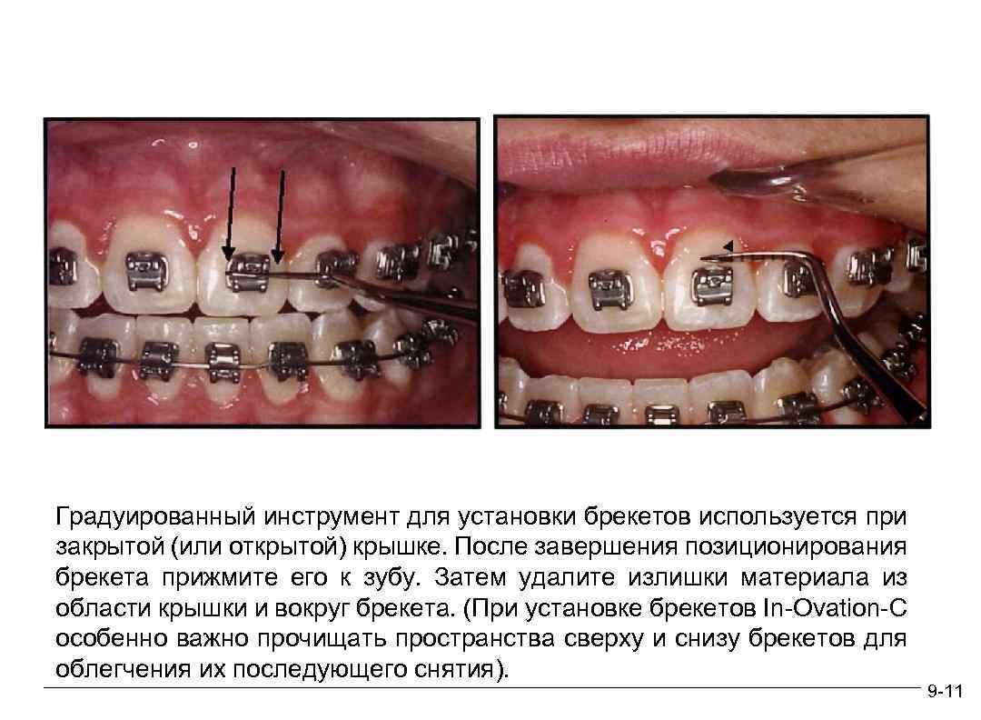 Градуированный инструмент для установки брекетов используется при закрытой (или открытой) крышке. После завершения позиционирования