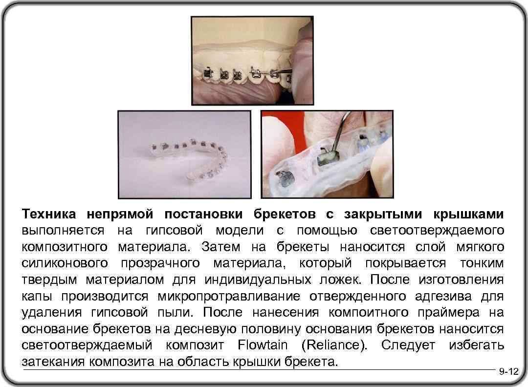 Техника непрямой постановки брекетов с закрытыми крышками выполняется на гипсовой модели с помощью светоотверждаемого