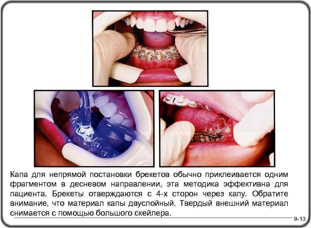 Капа для непрямой постановки брекетов обычно приклеивается одним фрагментом в десневом направлении, эта методика
