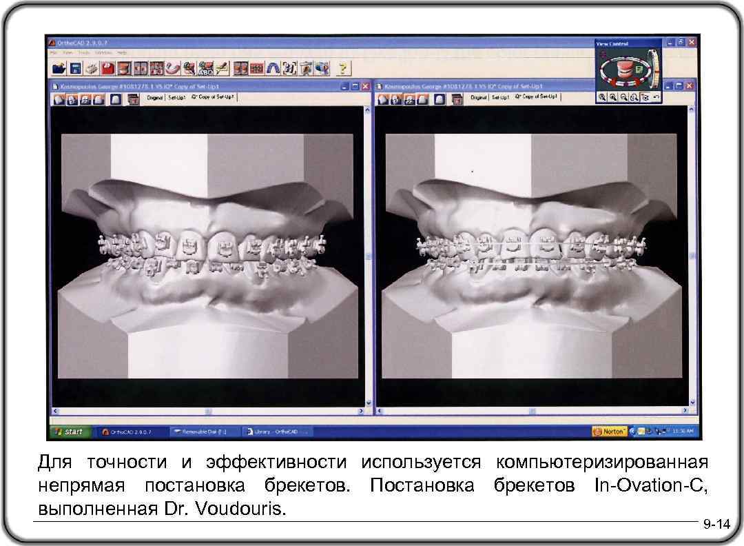 Для точности и эффективности используется компьютеризированная непрямая постановка брекетов. Постановка брекетов In-Ovation-C, выполненная Dr.