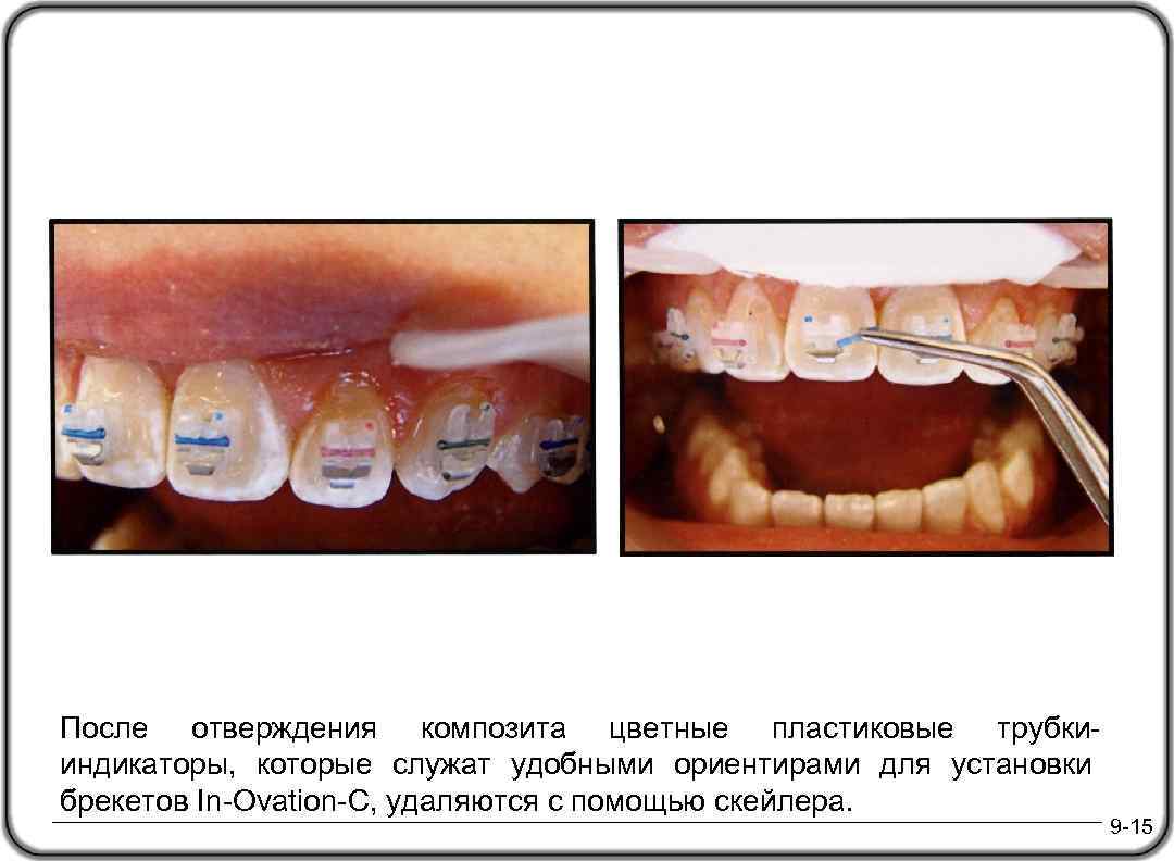 После отверждения композита цветные пластиковые трубкииндикаторы, которые служат удобными ориентирами для установки брекетов In-Ovation-C,