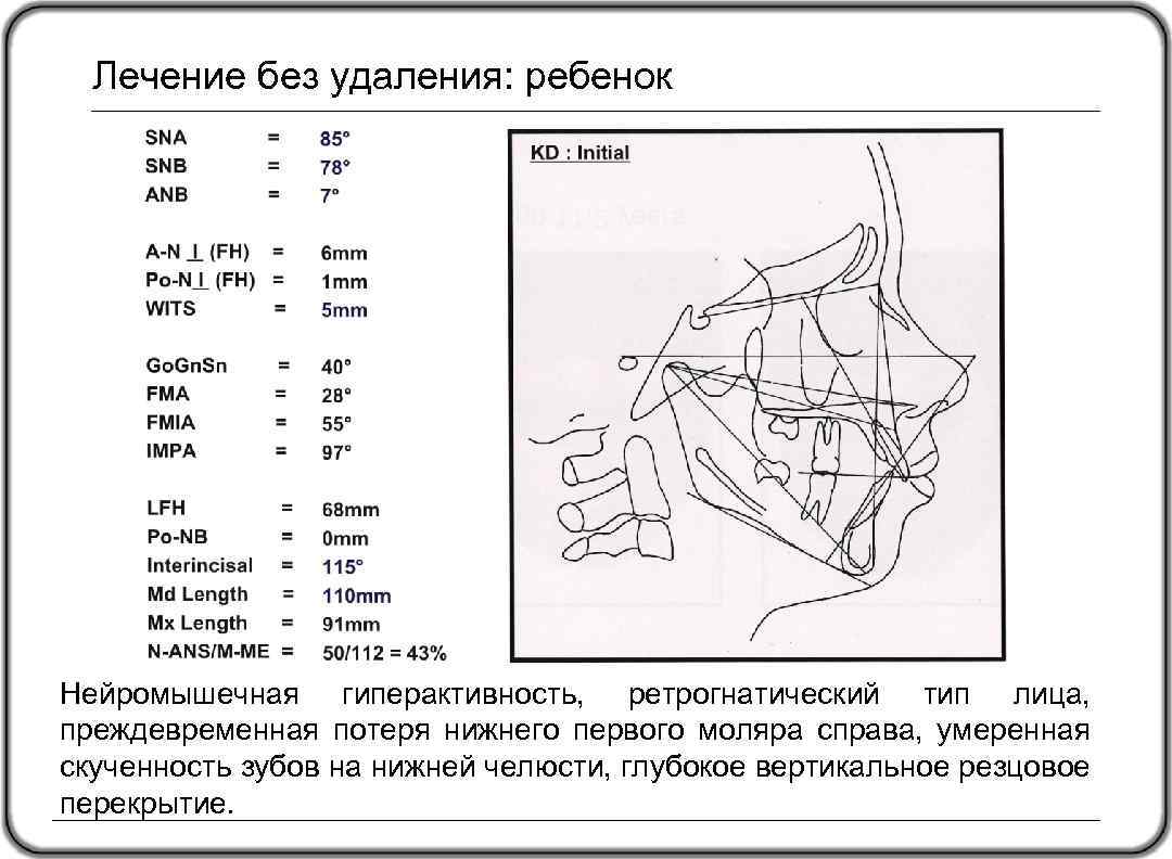 Лечение без удаления: ребенок Нейромышечная гиперактивность, ретрогнатический тип лица, преждевременная потеря нижнего первого моляра