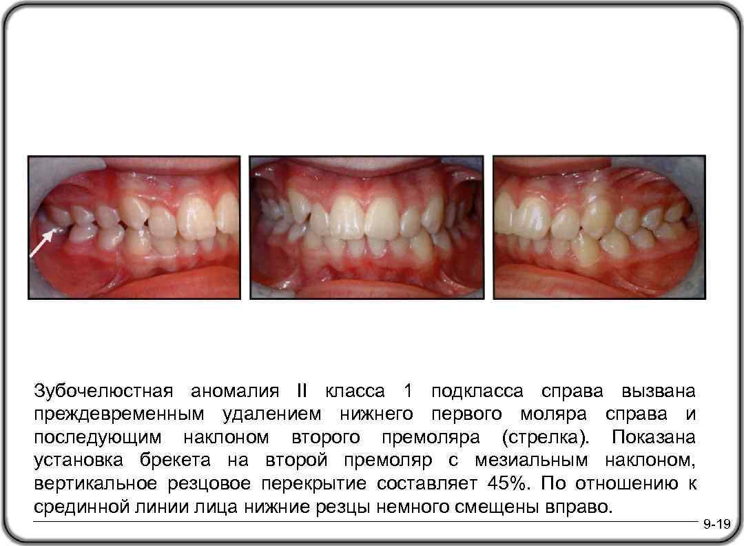Зубочелюстная аномалия II класса 1 подкласса справа вызвана преждевременным удалением нижнего первого моляра справа