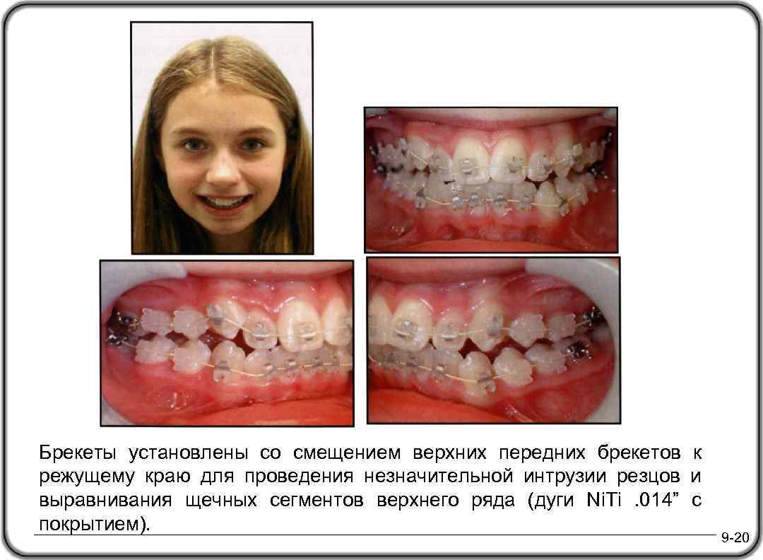 Брекеты установлены со смещением верхних передних брекетов к режущему краю для проведения незначительной интрузии