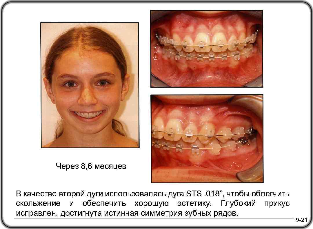 Через 8, 6 месяцев В качестве второй дуги использовалась дуга STS. 018”, чтобы облегчить
