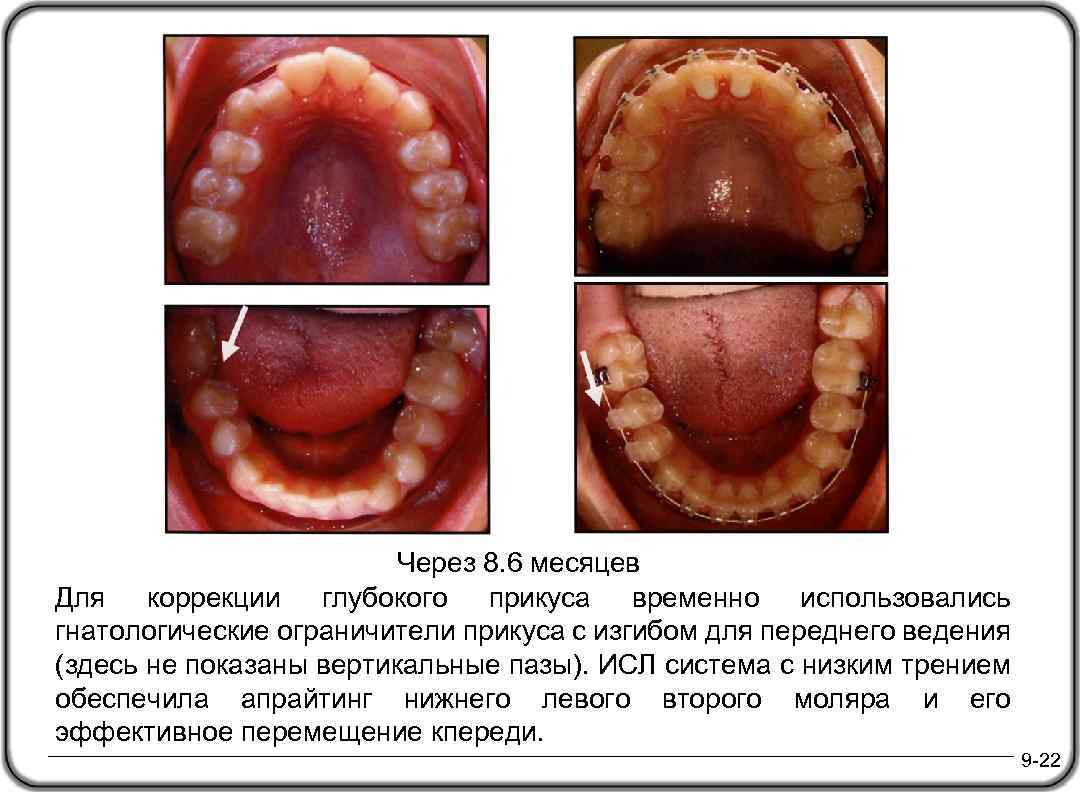 Через 8. 6 месяцев Для коррекции глубокого прикуса временно использовались гнатологические ограничители прикуса с