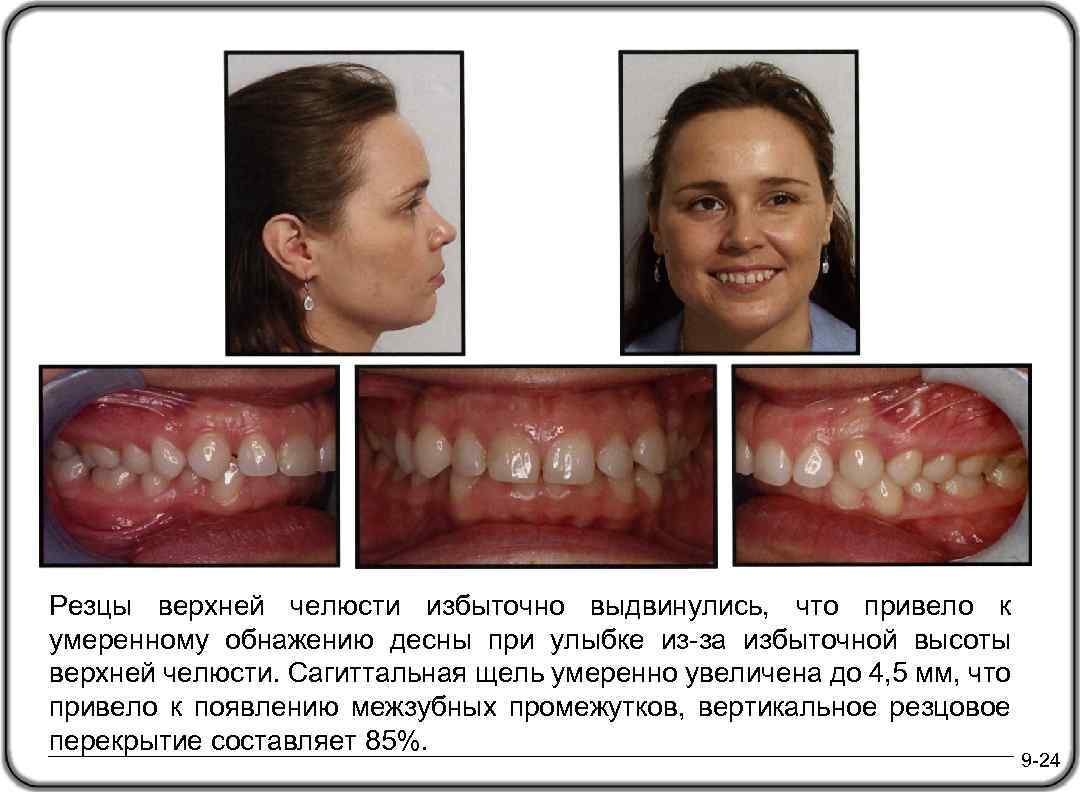 Резцы верхней челюсти избыточно выдвинулись, что привело к умеренному обнажению десны при улыбке из-за