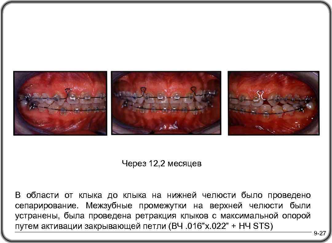 Через 12, 2 месяцев В области от клыка до клыка на нижней челюсти было