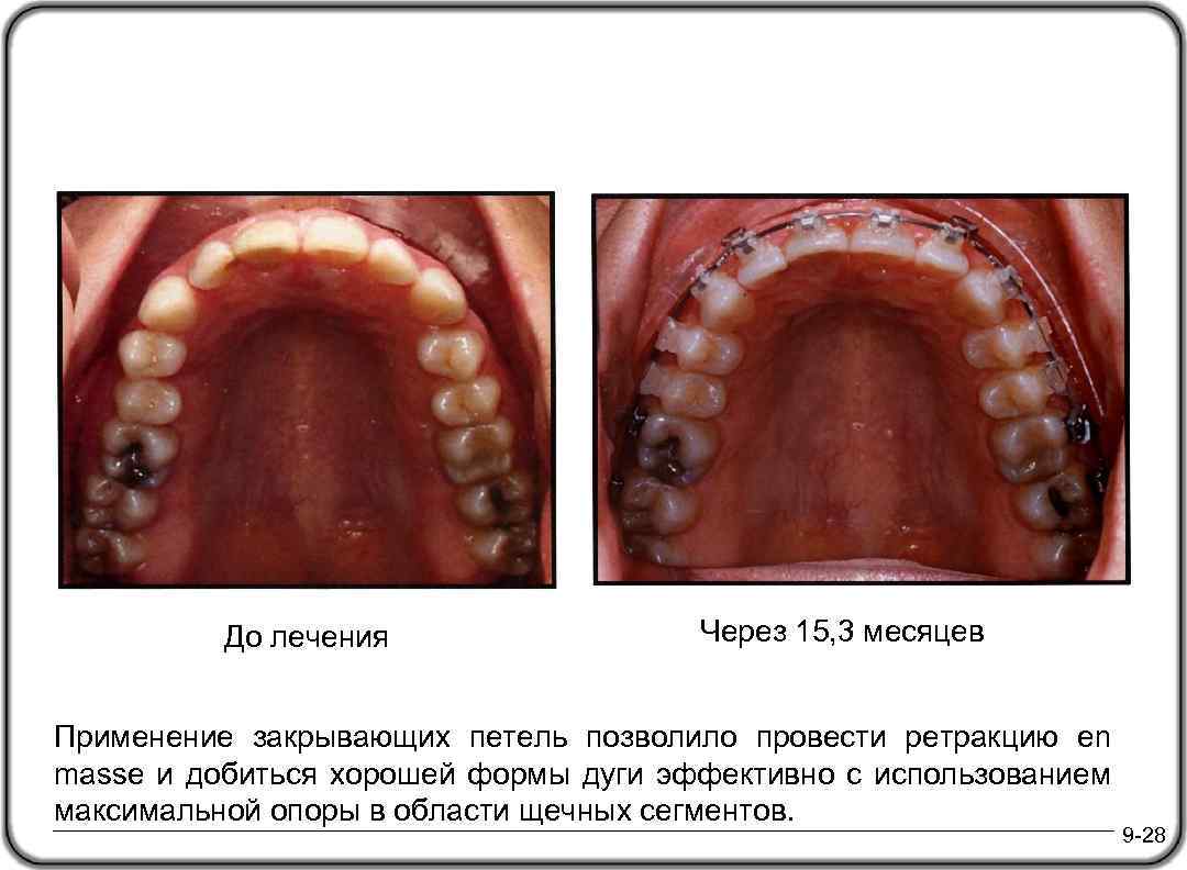 До лечения Через 15, 3 месяцев Применение закрывающих петель позволило провести ретракцию en masse