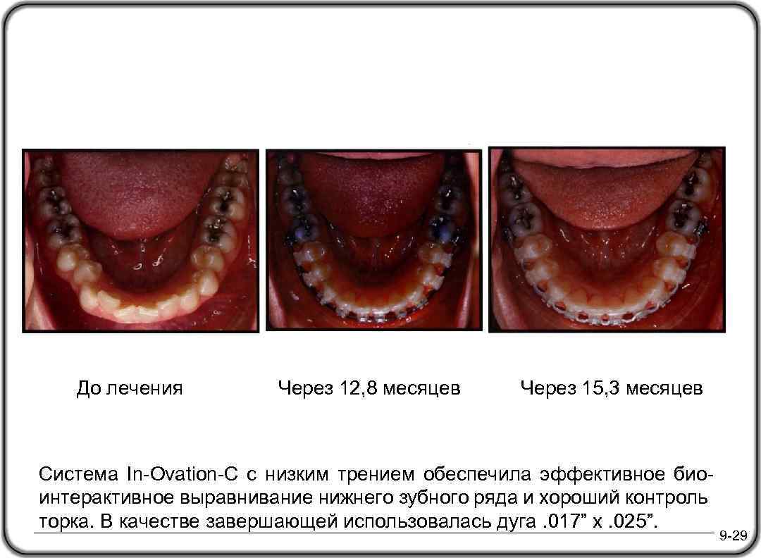 До лечения Через 12, 8 месяцев Через 15, 3 месяцев Система In-Ovation-C с низким