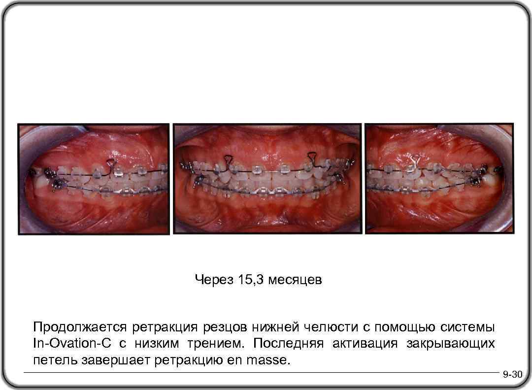 Через 15, 3 месяцев Продолжается ретракция резцов нижней челюсти с помощью системы In-Ovation-C с