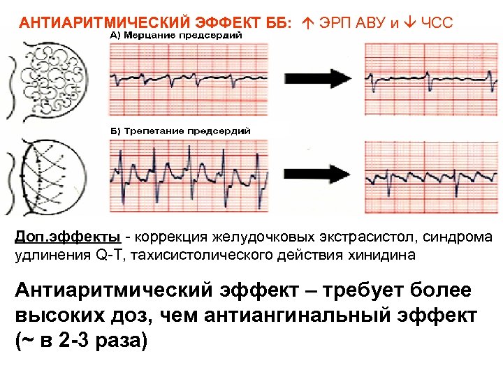АНТИАРИТМИЧЕСКИЙ ЭФФЕКТ ББ: ЭРП АВУ и ЧСС Доп. эффекты - коррекция желудочковых экстрасистол, синдрома