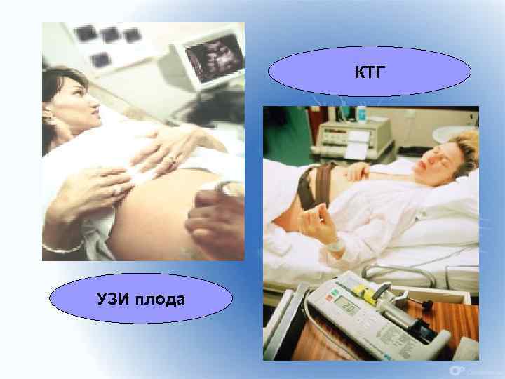 КТГ УЗИ плода 30 