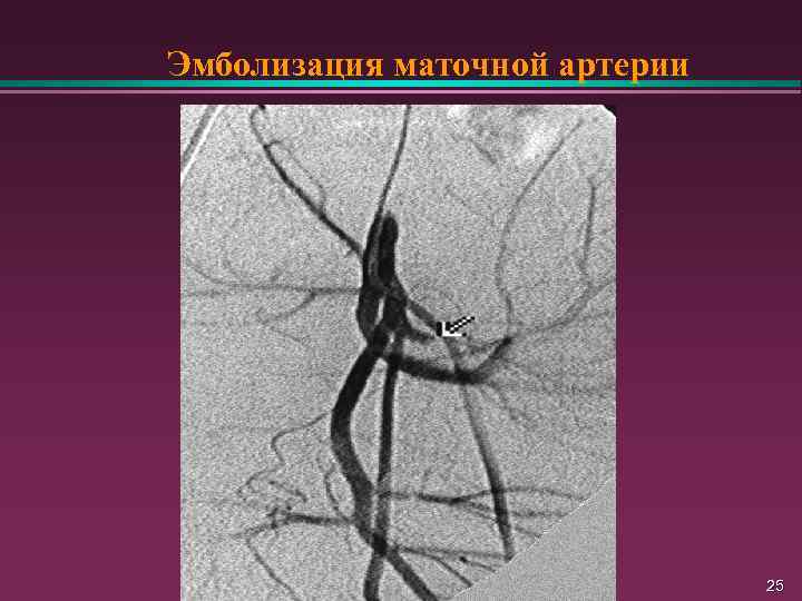 Эмболизация внутренних подвздошных артерий. Эмболизация щитовидной артерии. Презентация на тему эмболизация маточных артерий. Эмболизация ветвей внутренней подвздошной артерии.