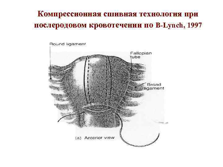 Компрессионная сшивная технология при послеродовом кровотечении по B-Lynch, 1997 