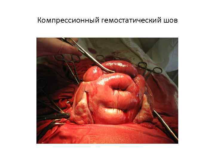 Компрессионный гемостатический шов 