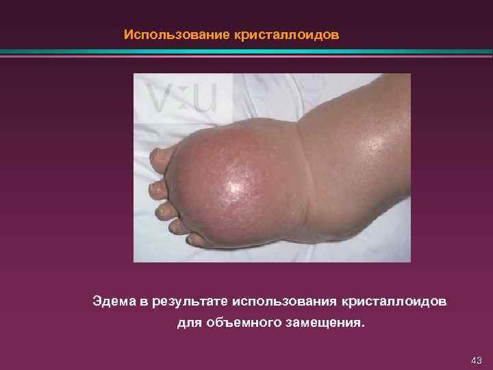 Использование кристаллоидов Эдема в результате использования кристаллоидов для объемного замещения. 43 