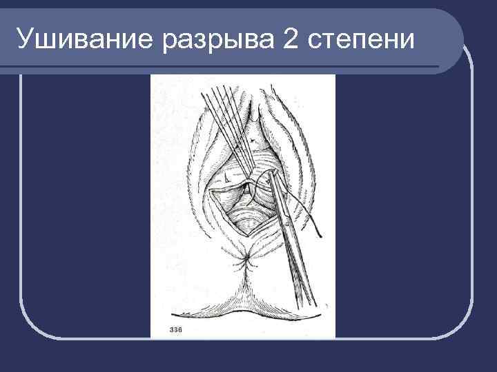 Ушивание разрыва 2 степени 