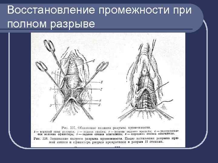 Восстановление промежности при полном разрыве 