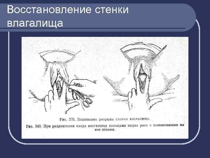 Восстановление стенки влагалища 