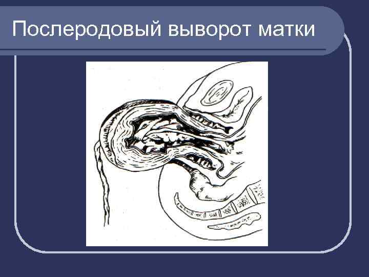 Послеродовый выворот матки 