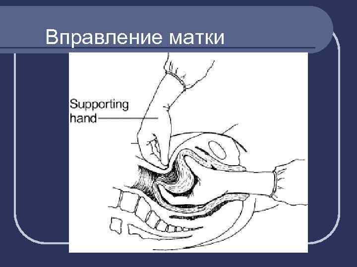 Вправление матки 