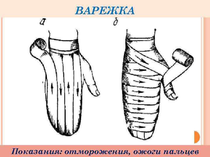 ВАРЕЖКА Показания: отморожения, ожоги пальцев 