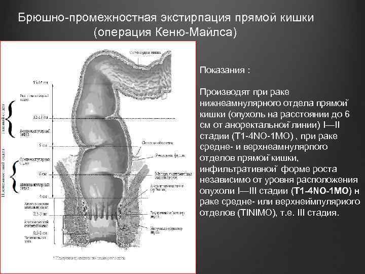  Брюшно-промежностная экстирпация прямой кишки (операция Кеню-Майлса) Показания : Производят при раке нижнеамнулярного отдела