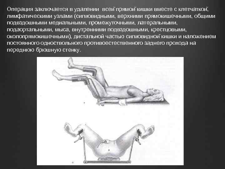 Операция заключается в удалении всеи прямои кишки вместе с клетчаткои , лимфатическими узлами (сигмовидными,