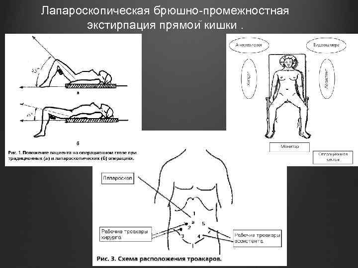 Лапароскопическая брюшно-промежностная экстирпация прямои кишки. 
