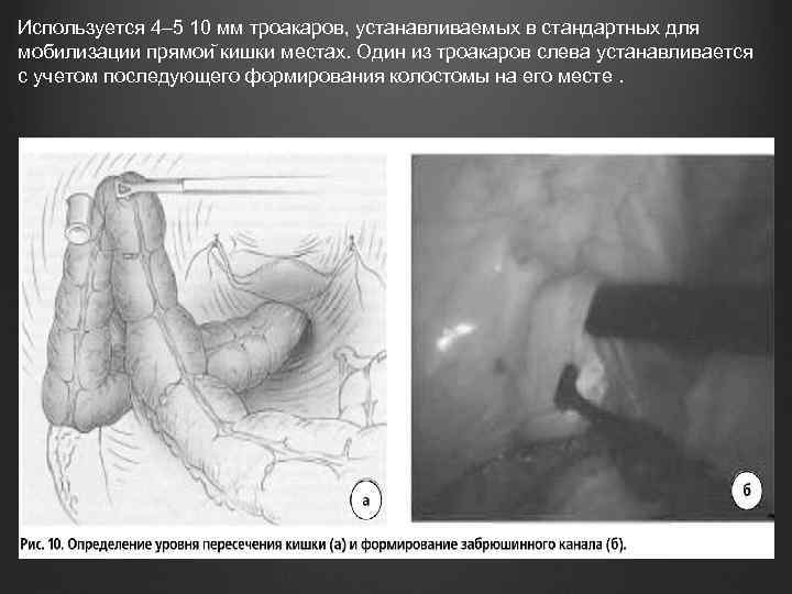 Используется 4– 5 10 мм троакаров, устанавливаемых в стандартных для мобилизации прямои кишки местах.