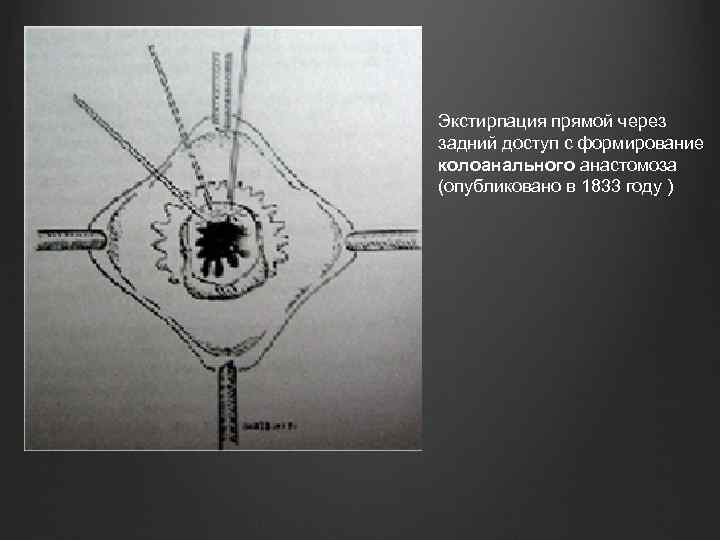 Экстирпация прямой через задний доступ с формирование колоанального анастомоза (опубликовано в 1833 году )