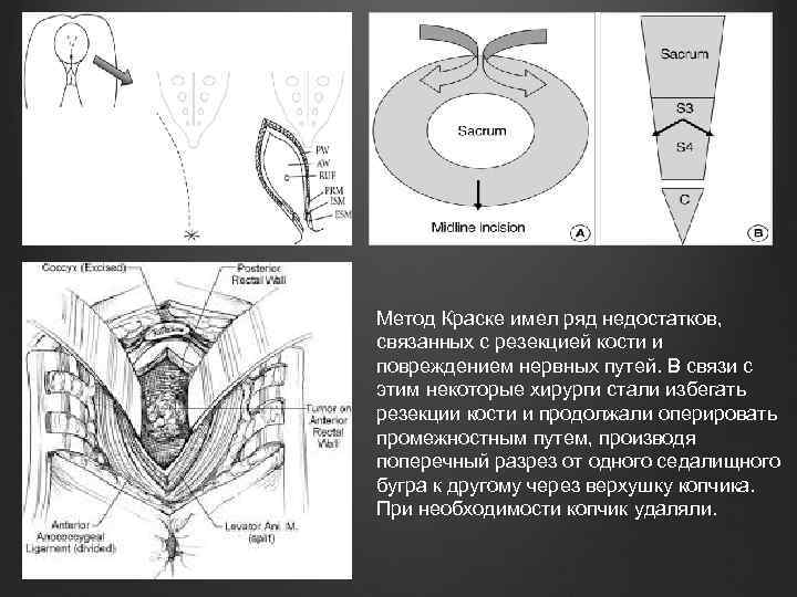 Метод Краске имел ряд недостатков, связанных с резекцией кости и повреждением нервных путей. В