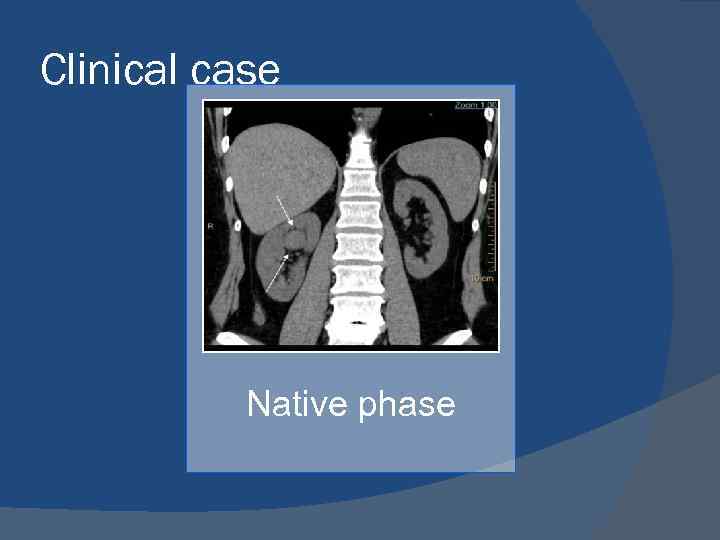 Clinical case Native phase 