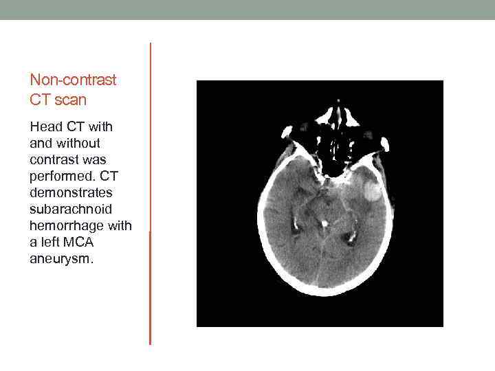 Non-contrast CT scan Head CT with and without contrast was performed. CT demonstrates subarachnoid