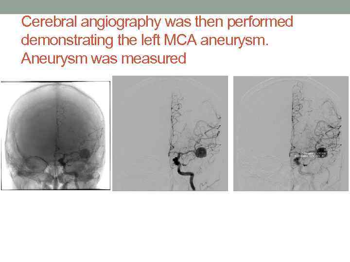 Cerebral angiography was then performed demonstrating the left MCA aneurysm. Aneurysm was measured 