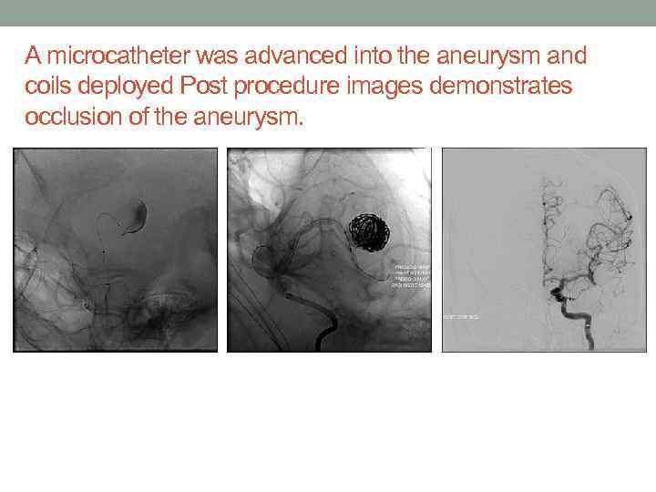 A microcatheter was advanced into the aneurysm and coils deployed Post procedure images demonstrates