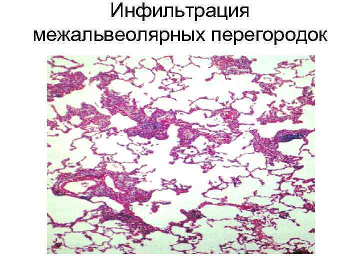 Инфильтрация межальвеолярных перегородок 