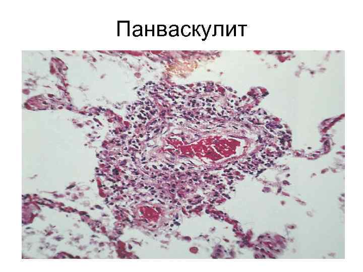 Панваскулит 