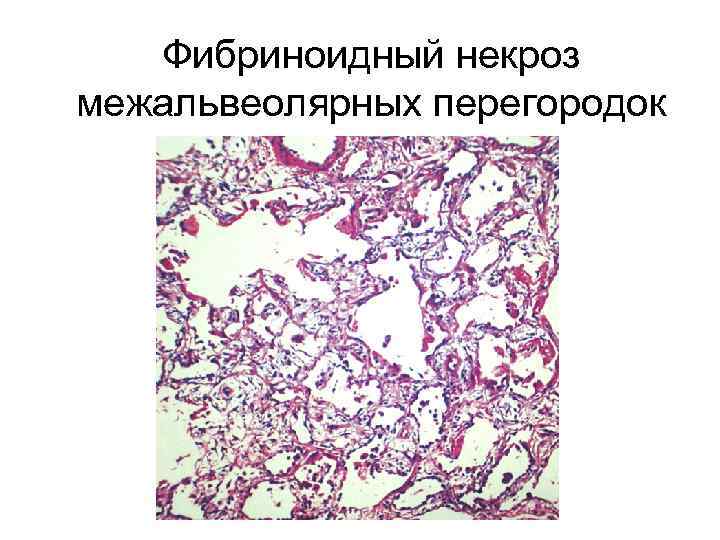 Фибриноидный некроз межальвеолярных перегородок 